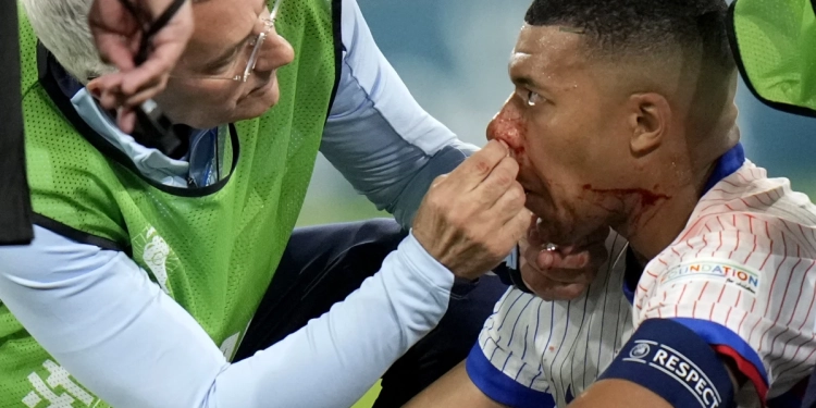 Kylian Mbappé due for tests on his broken nose as France gets ‘positive’ news on top star